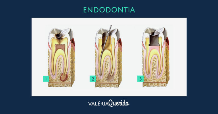 O Que é Endodontia E Quais São Os Tratamentos Dessa Especialidade ...